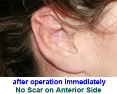 plastic-surgery-prominent-ear 